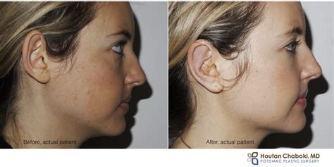 belo otoplasty price|Cosmetic Ear Surgery: How Otoplasty Works, Recovery, Cost & More .